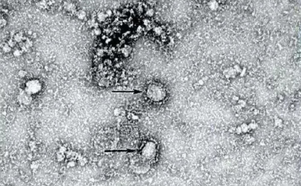 Первый выздоровевший от коронавируса китаец назвал симптомы этой болезни