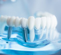 Новое в стоматологии: имплантация за несколько дней