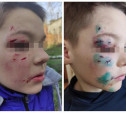 В Ясногорске бродячая собака искусала ребёнку лицо: следователи начали проверку