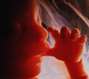Минздрав не поддерживает идею отказа от бесплатных абортов