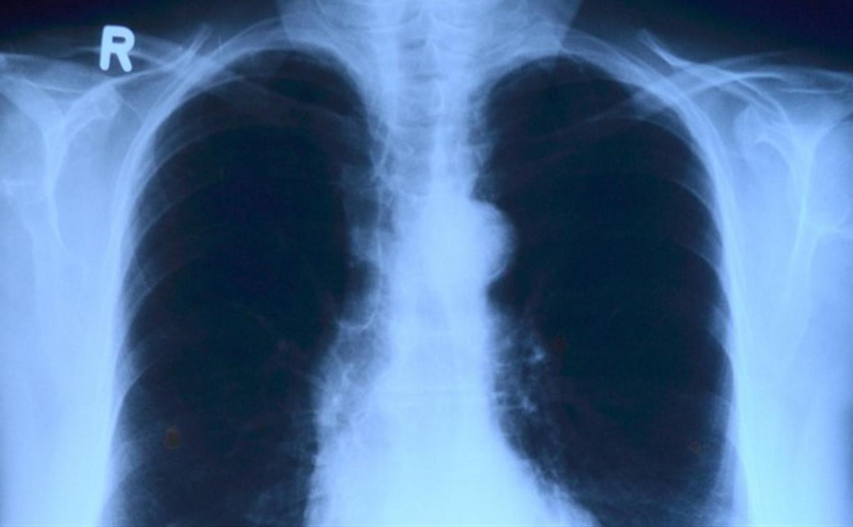 В Тульской области четверых больных туберкулезом принудительно положили в стационар  
