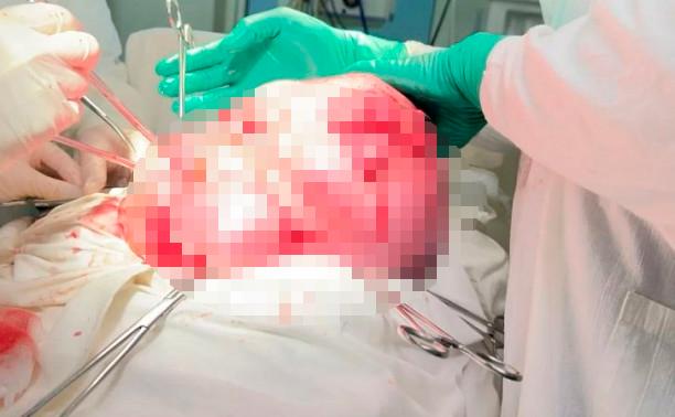 Тулячке удалили опухоль матки весом 14 кг