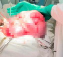 Тулячке удалили опухоль матки весом 14 кг
