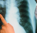 В Новомосковске пациент с туберкулезом сбежал от врачей