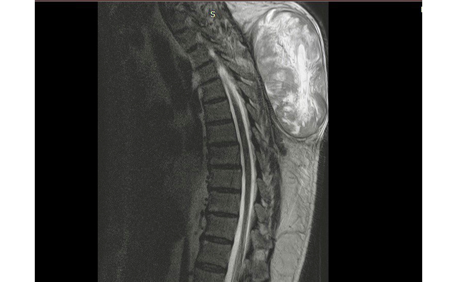 Тульские медики удалили у пациента огромную опухоль позвоночника весом более 4 килограммов