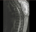 Тульские медики удалили у пациента огромную опухоль позвоночника весом более 4 килограммов
