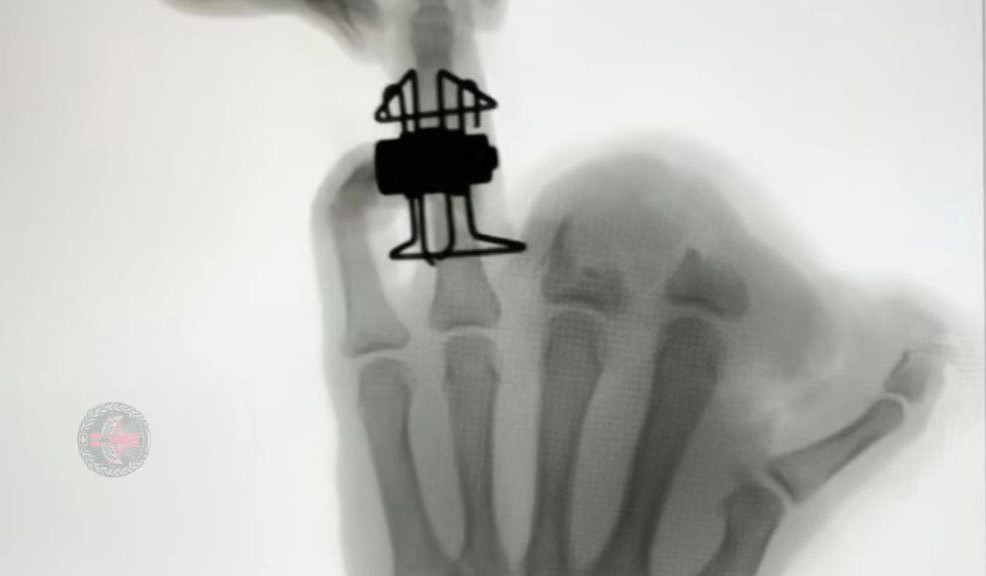 Тульские военные медики в зоне СВО изобрели аппарат для лечения сложных переломов пальцев