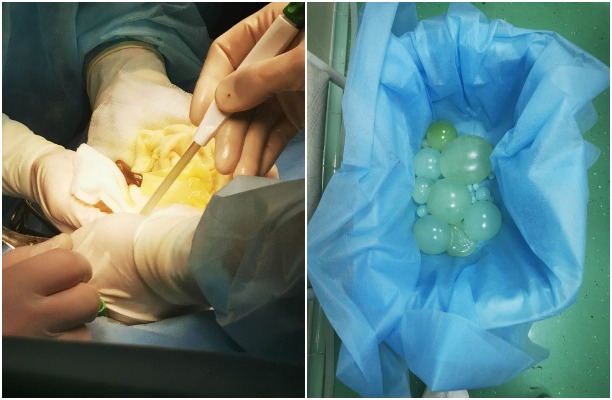 В Туле хирурги достали из живота мужчины гигантские кисты с личинками