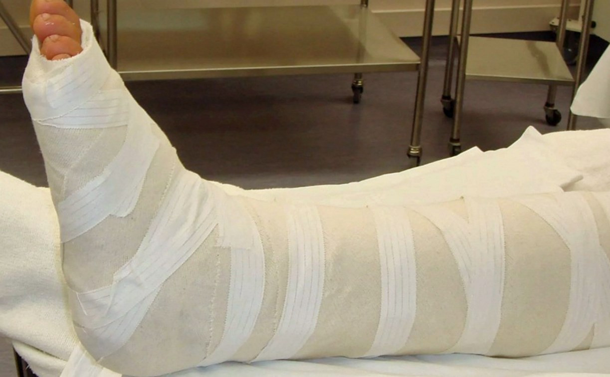 В Тульской области пьяный мужчина сам сломал ногу и написал заявление в полицию на зятя