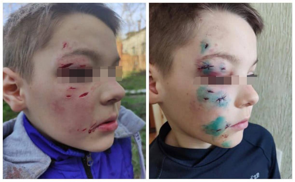 В Ясногорске бродячая собака укусила ребёнка за лицо