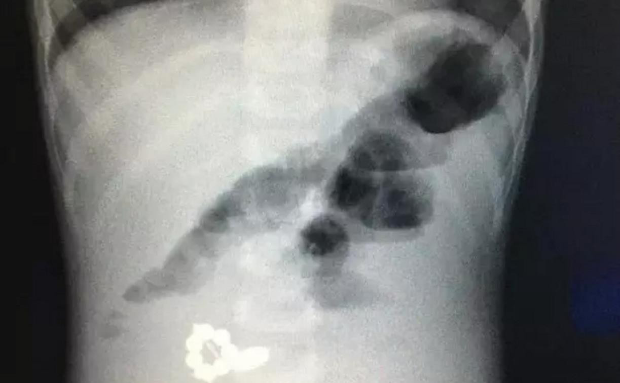 Проглотил батарейку и магниты: в Туле врачи спасли полуторагодовалого малыша