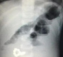Проглотил батарейку и магниты: в Туле врачи спасли полуторагодовалого малыша