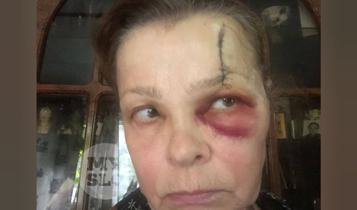 Житель Венева натравил стаффа на соседку: женщина получила травму головы