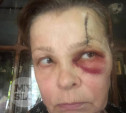 Житель Венева натравил стаффа на соседку: женщина получила травму головы