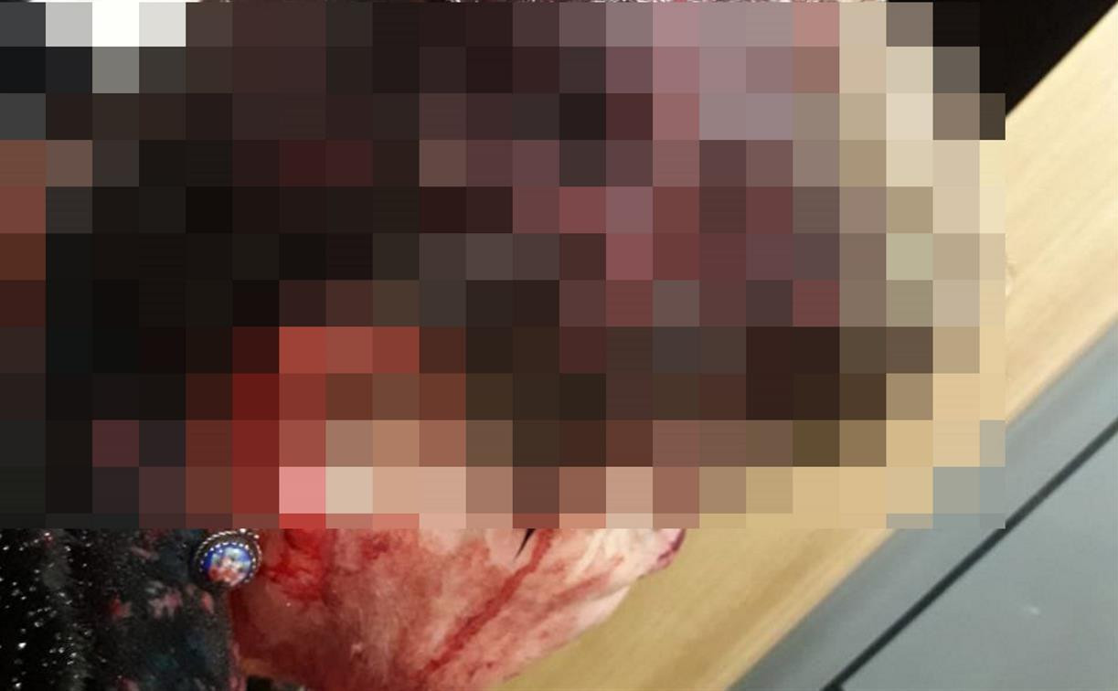 Нападение с лопатой на врача-педиатра: у пострадавшей рваные раны головы и сломана рука